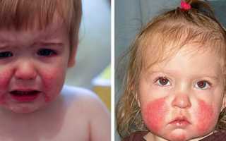 Сыпь у ребенка на лице