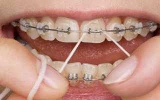 Как чистить зубы с брекетами — инструкция и дополнительные рекомендации