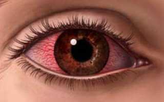 Что делать при сухости глаз: причины и лечение