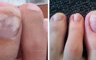 Белые пятна на ногтях ног