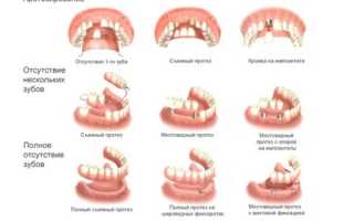 Зубное протезирование: виды