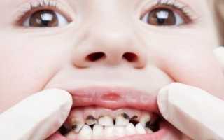 Гнилые зубы у детей — как защититься и правильно лечить