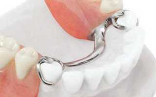 Бюгельные зубные протезы — виды, надежность, отзывы и цены