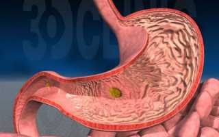 Как проявляются симптомы гастрита и язвы желудка у взрослых