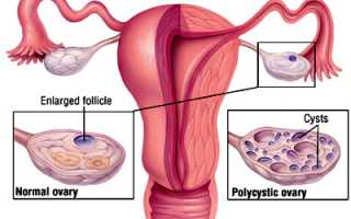 Чем опасна киста яичника: симптомы у женщин