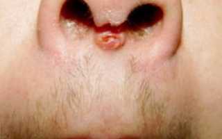 Инфекция пирсинга на перегородке носа (септума)