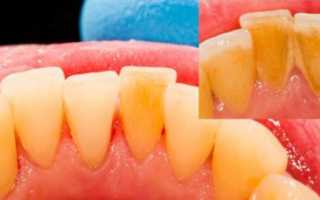Как почистить зубной камень в домашних условиях — рекомендации экспертов