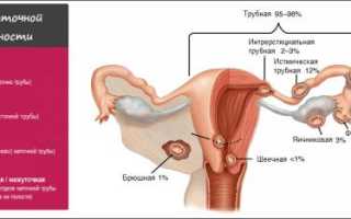Особенности протекания и лечения трубной внематочной беременности