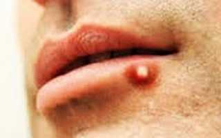 Красные или белые болячки на губах
