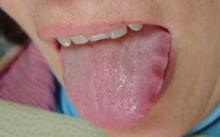 Неровные края языка (зубчатый язык)