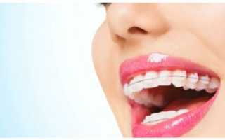 Сапфировые брекеты на зубы — плюсы и минусы, особенности ухода, цены и отзывы людей