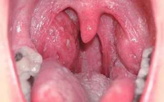 Боль в горле как симптом заболеваний