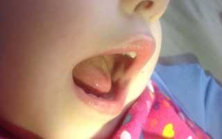 Черные точки во рту на щеке