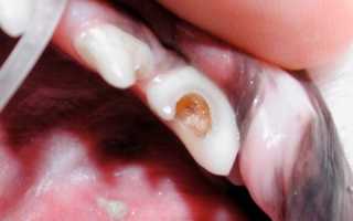 Что делать при сильной зубной боли