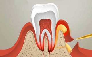 Абсцесс зуба и его лечение в домашних условиях