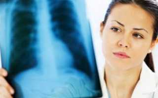 Первые признаки и симптомы туберкулеза на ранней стадии у взрослых