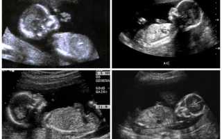 18 неделя беременности: развитие малыша, изменения в организме мамы