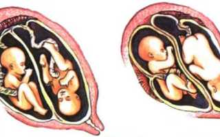 Двойное счастье и двойные риски: различные аспекты многоплодной беременности