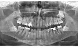 Панорамный снимок зубов — где делают и нужно ли опасаться процедуры