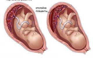 Транексам — кровоостанавливающее средство при беременности