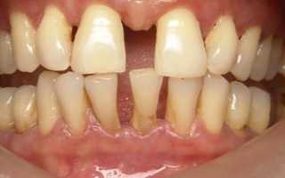 Шинирование зубов: виды и методика
