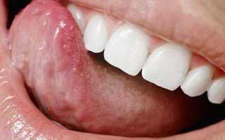 Болит кончик языка: причины, симптомы, способы лечения