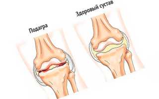 Распространенные причины ноющей боли в коленном суставе — эффективное лечение
