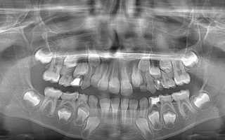 Обточка зубов под металлокерамику