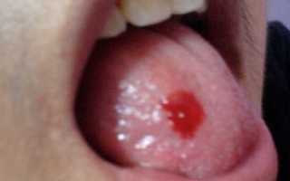 Кровотечение из языка