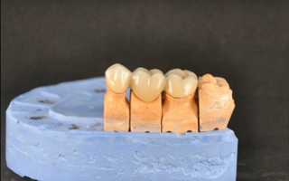 Коронки на зубы – надежное решение серьезных проблем с зубами