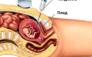 Чем опасно маловодие при беременности, как его диагностируют и лечат