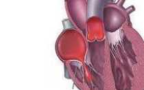 Физиологическая регургитация на клапане легочной артерии