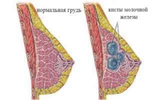 Боль в груди во время и после овуляции: норма или патология