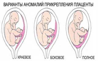 Отслойка плаценты на разных сроках беременности