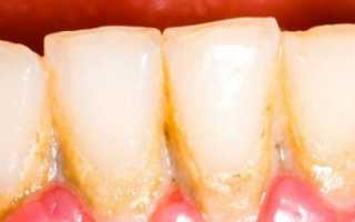 Удаление зубного камня ультразвуком — достоинства и недостатки методики