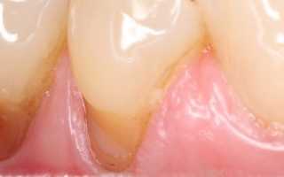Клиновидный дефект зубов — причины, симптомы и лечение тяжелого стоматологического заболевания