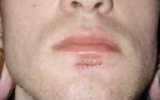 Шрам от пирсинга губы