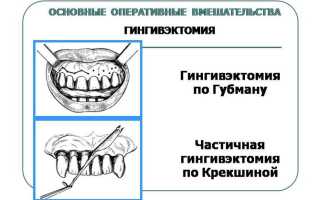 Гингивэктомия в стоматологии — восстановление нормального положения пародонта