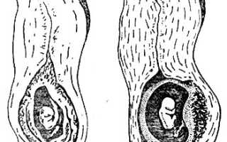 Шеечная беременность: сущность проблемы и методы её лечения