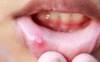 Болит полость рта