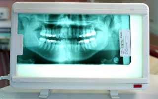 Дистопированный зуб — виды, причины, а также методики устранения проблемы