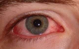 Как лечить воспаление глаза в домашних условиях