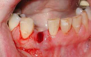 Полоскание после удаления зуба для заживления десны
