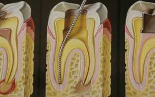 Почему болит зуб после лечения пульпита? Частые ошибки врачей