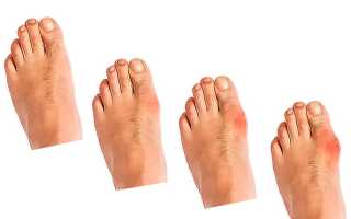 Причины боли в большом пальце на ноге — эффективные методы лечения