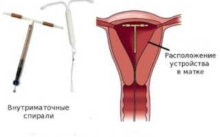 Методы контрацепции: как предохраняться от нежелательной беременности