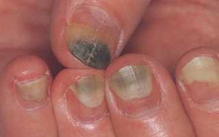 Плохие, поврежденные ногти