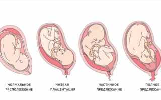 Предлежание плаценты: что это такое и как она влияет на беременность и роды