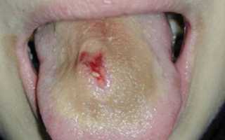 Воспаление и занесение инфекции при пирсинге языка