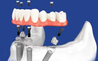 Зубы за 1 день – современные методы имплантации челюсти
